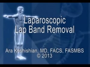 Laparoscopic Lap-Band® Removal