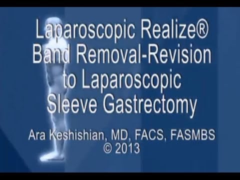 Laparoscopic Realize® Band Removal-Revision to Sleeve Gastrectomy