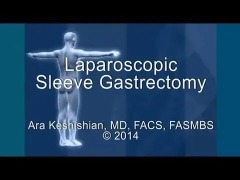 Laparoscopic Sleeve Gastrectomy