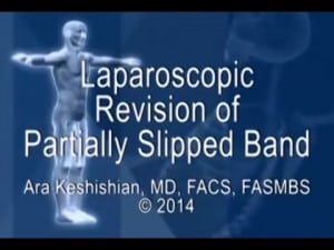 Laparoscopic Revision of Partially Slipped Band