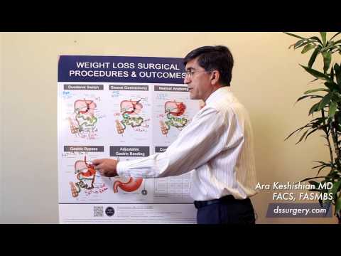 Weight Loss Surgical Procedures Part 7 - Summary