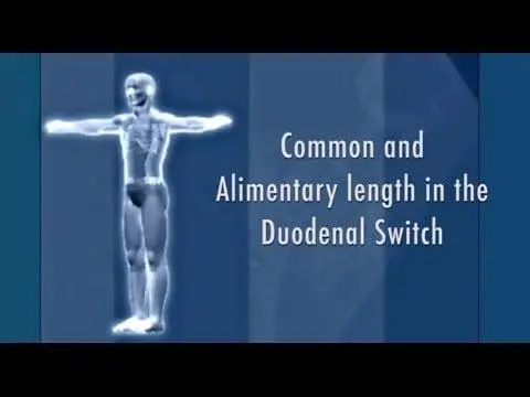Length Measurement in Duodenal Switch