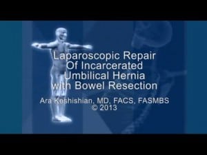 Laparoscopic Repair of Incarcerated Umbilical Hernia with Bowel Resection