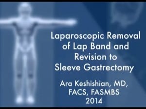 Lap Band Removal and Revision to Sleeve Gastrectomy