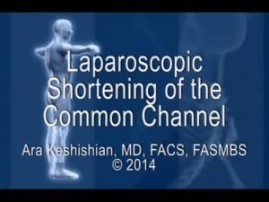 Laparoscopic Shortening of the Common Channel