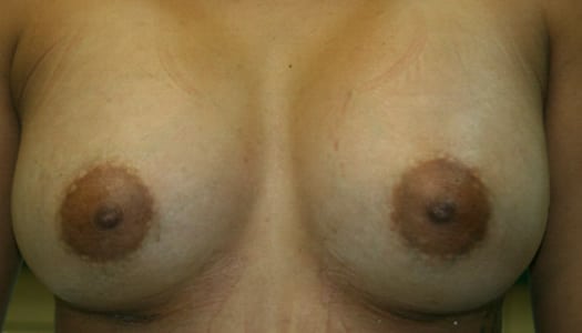 After- Mammaplasty (Breast Augmentation)