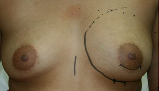 Before- Mammaplasty (Breast Augmentation)