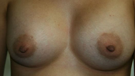 After-Mammaplasty (Breast Augmentation)