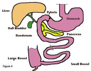 bowel-obstruction-04 - DSSurgery