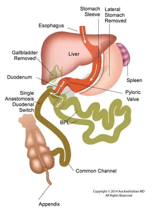 After-Duodenal Switch vs SADI
