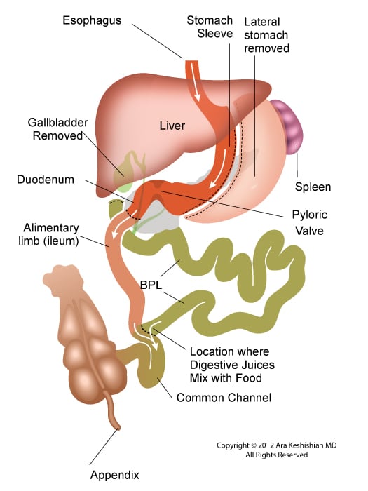 After-Gastric Bypass (RNY) vs Duodenal Switch