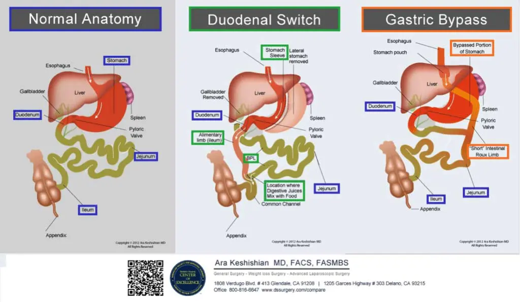 Ara-pict-anemia-1024x595 Weight loss surgical procedures and outcomes.