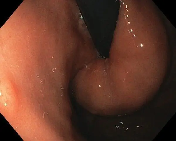 100H0004-600x480 Long Term Complications of Adjustable Gastric Banding