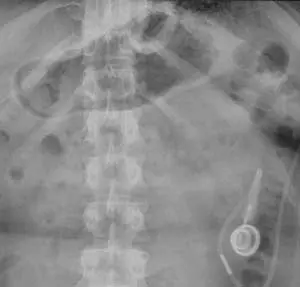Partially-slipped-band-300x287 Long Term Complications of Adjustable Gastric Banding
