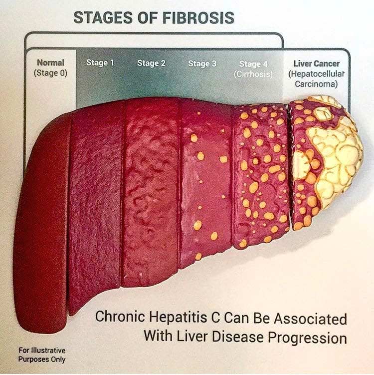 Stages of Liver Injury and Fibrosis