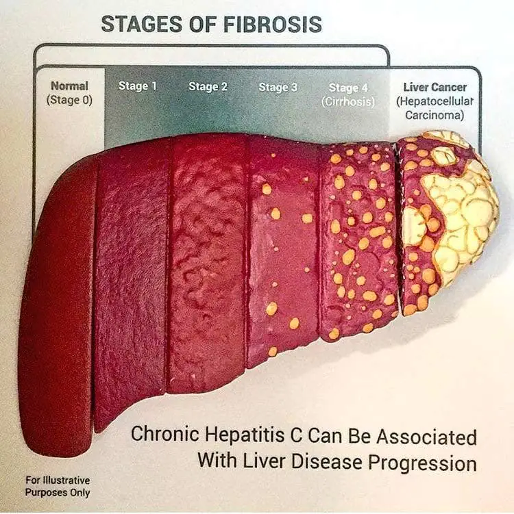 C5AmqFbWYAEAQ0v Stages of Liver Injury and Fibrosis