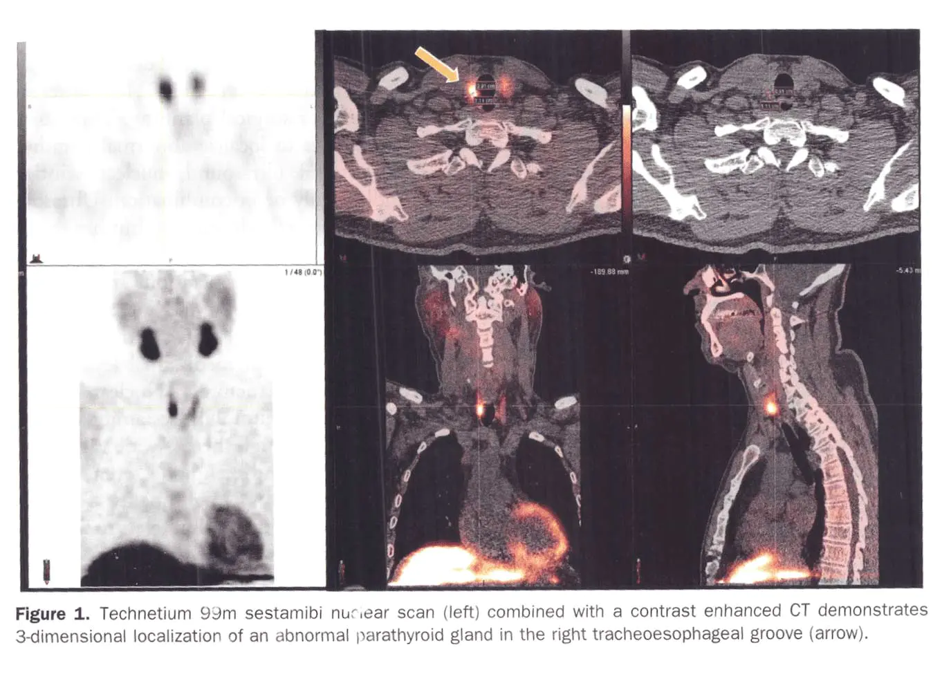 Screen-Shot-2018-06-09-at-11.46 Parathyroid Scan
