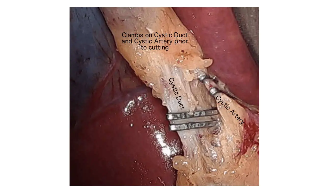 Clipped_Cystic_DuctandArtery