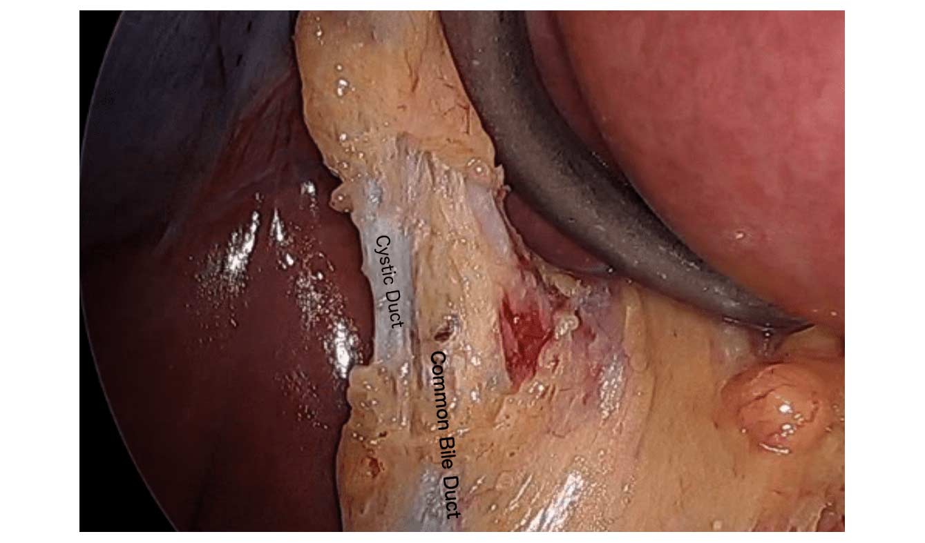 Common_Cystic-Duct