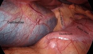 Gallbladder, Duct and Duodenum