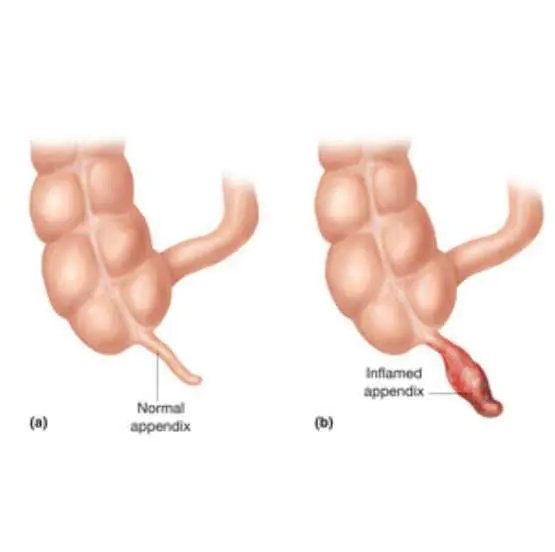 Normal-and-Inflamed-Appendix Normal-and-Inflamed-Appendix