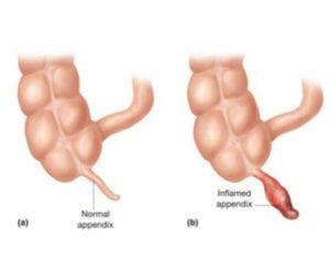 Normal and Inflamed Appendix