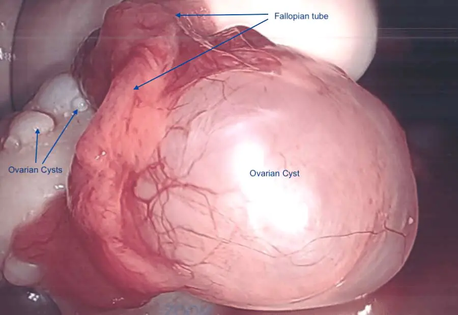 Poly Cystic Ovarian Syndrome Poly Cystic Ovarian Syndrome