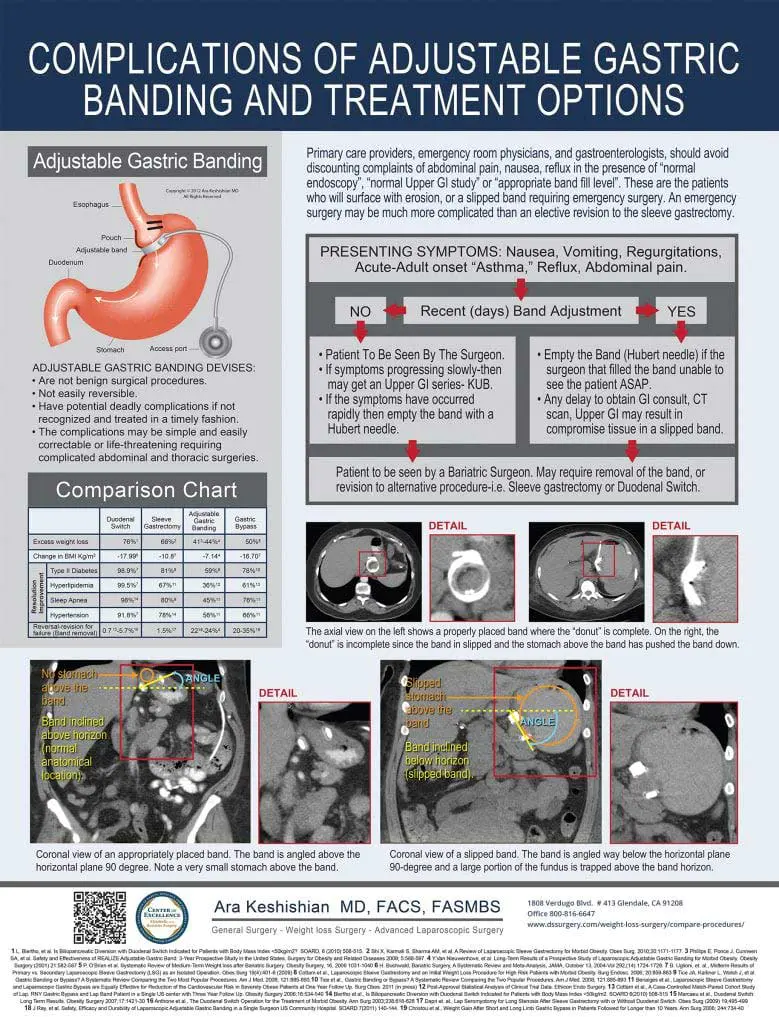 Complications-of-Adjustable-Gastric-Banding-and-Treatment-Options Complications-of-Adjustable-Gastric-Banding-and-Treatment-Options