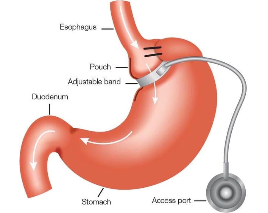 Adjustable-Gastric-Banding-DS-Surgery