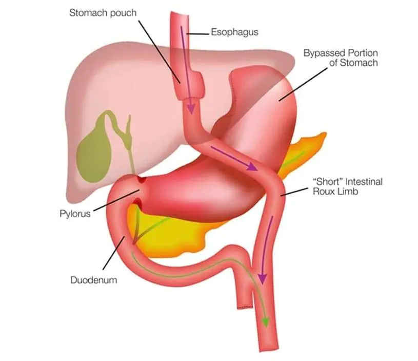 Gastric-Bypass-RNY-DS-Surgery Gastric-Bypass-RNY-DS-Surgery