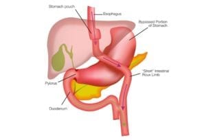 Gastric-Bypass-RNY-DS-Surgery