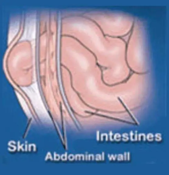 inguinal-hernia