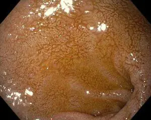 Bile Reflux Gastritis