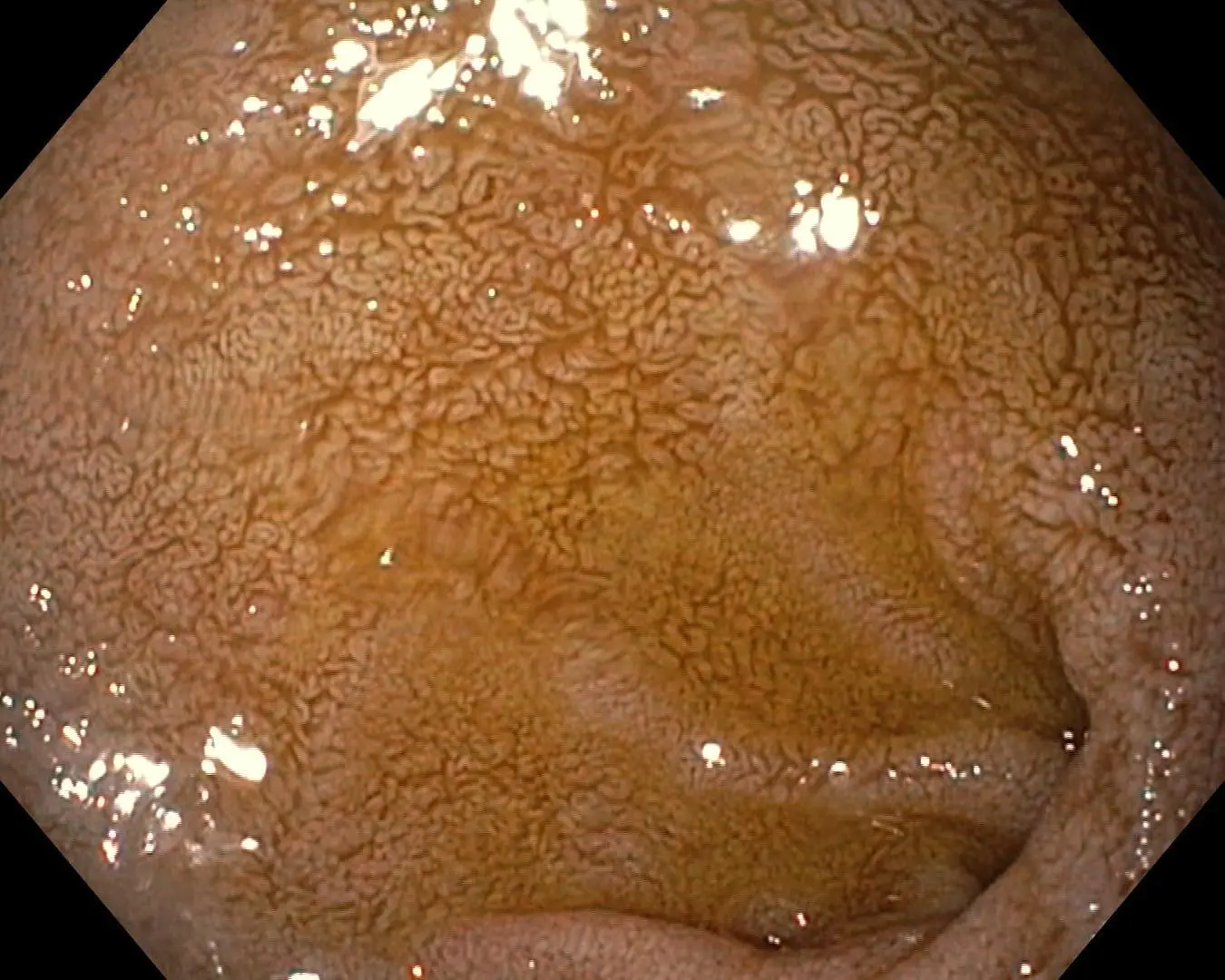 100H0002-min Bile Reflux Gastritis