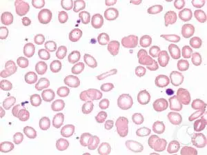4045_full1-300x225 Microcytic Red Blood Cells