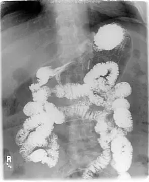 AP-SUPINE Bowel Obstruction After DS