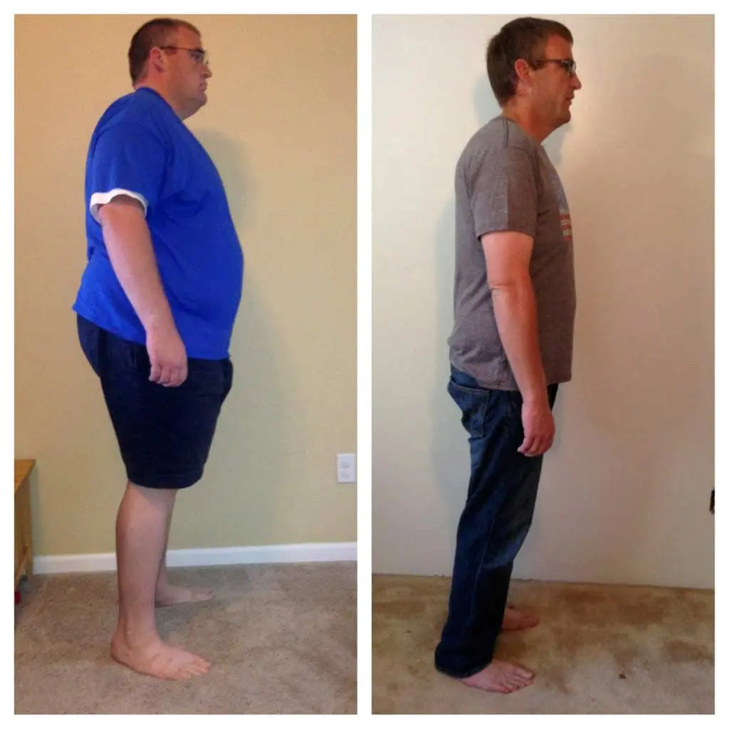 Before and after Duodenal Switch