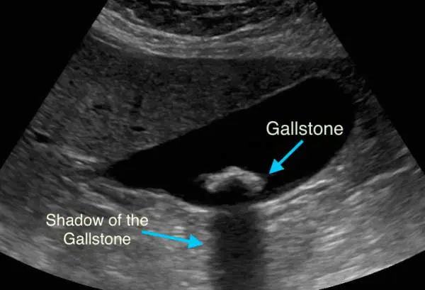 Gallstone--600x409 Gallstone