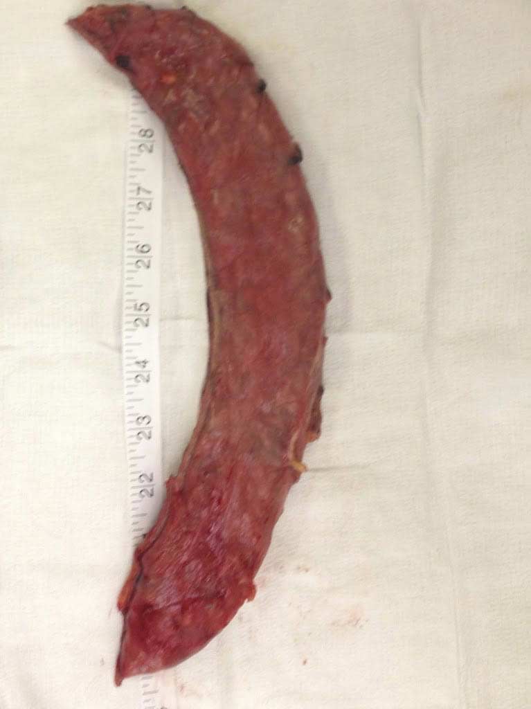 Stricture after Sleeve Gastrectomy Duodenal Switch