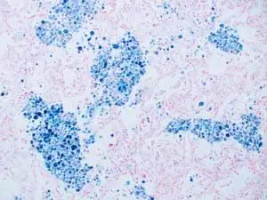 Intra-alveolar_hemosiderin_deposition_-_Prussian_blue_stain1-300x225 Prussian blue staining of RBC