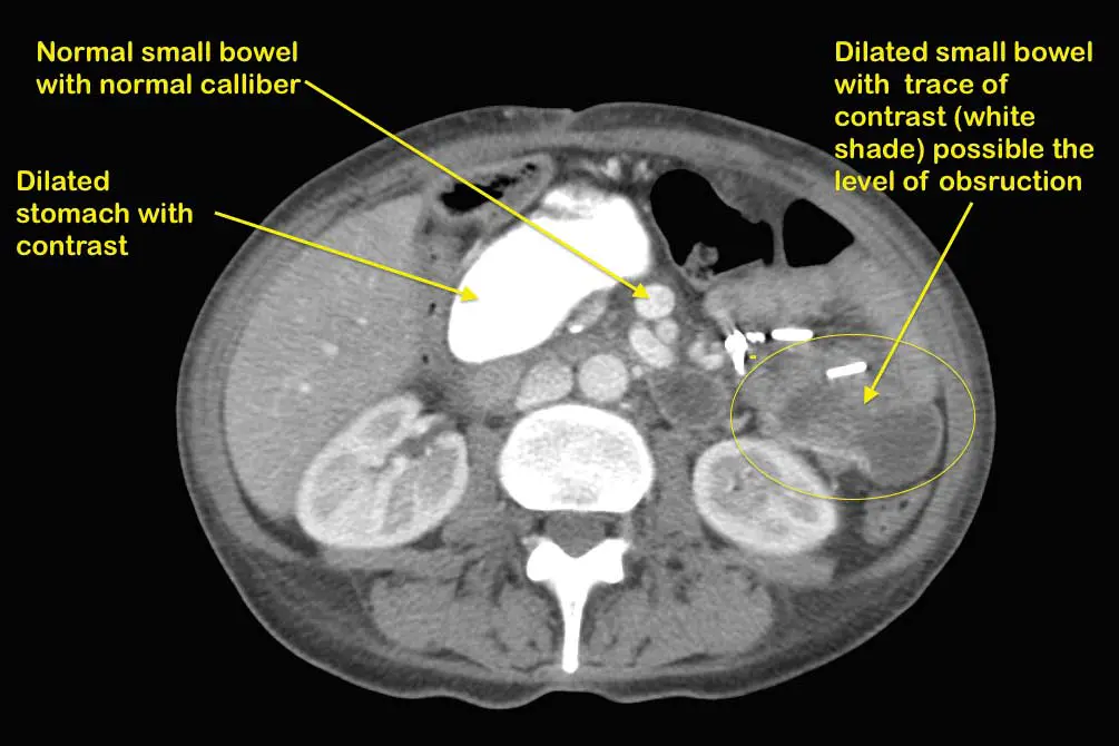 SBO Bowel Obstruction After DS