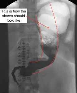 Screen-Shot-2015-08-26-at-7.48 Stricture after Sleeve Gastrectomy Duodenal Switch
