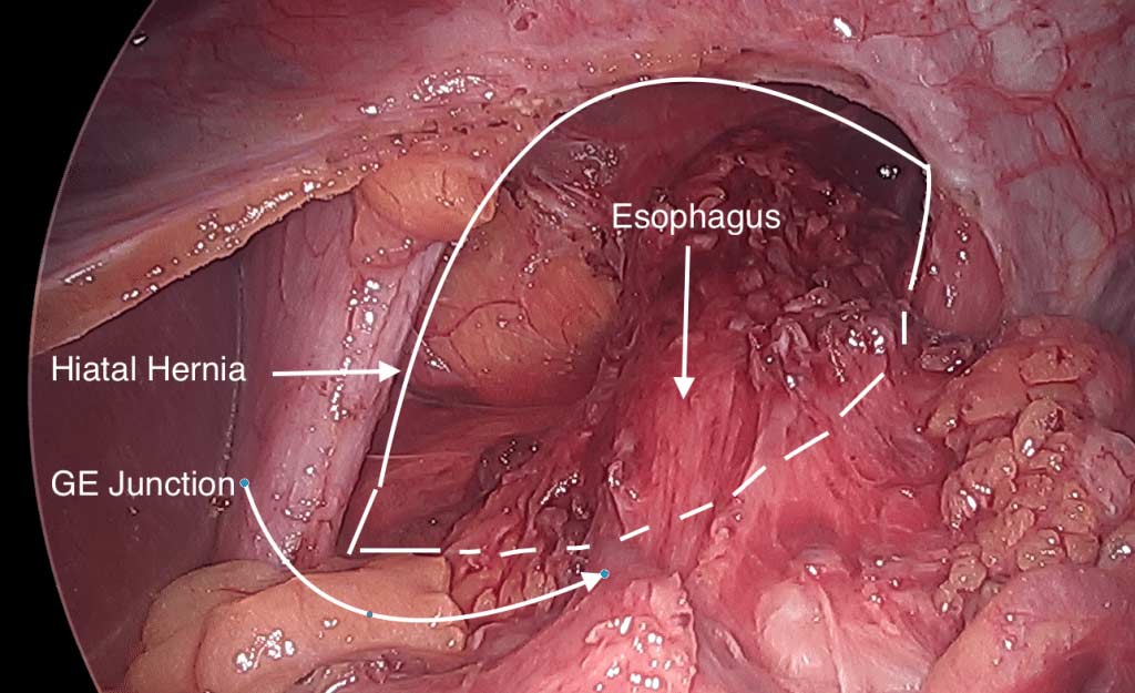 Surgical View of Hiatal Hernia