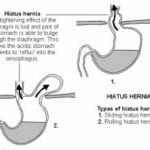 Hiatus Hernia Types