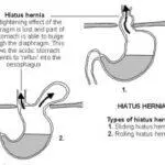 Screen-Shot-2016-02-18-at-7.38 Hiatus Hernia Types