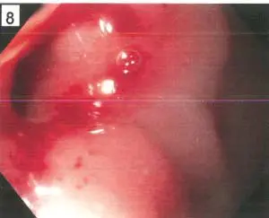 Stricture-300x243 First EGD of Duodenal Stricture
