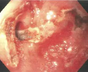 Stricture-and-ulcer-300x246 Second EGD with Duodenal Stricture and Ulceration