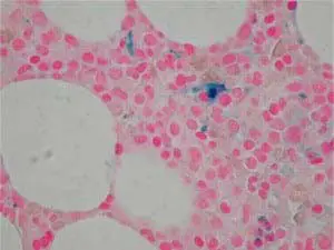 bone-marrow-biopsy1-300x225 bone-marrow-biopsy