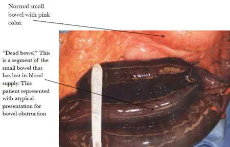 bowel-obstruction-01 bowel-obstruction-01
