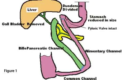 bowel-obstruction-02 bowel-obstruction-02